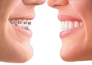 Traditional Braces  Benefits Of Braces