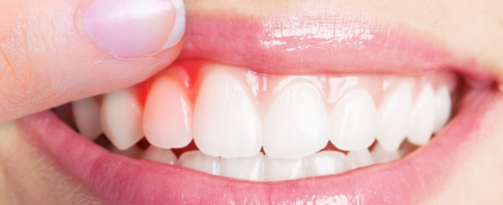 Periodontal Disease-Dentist in Atascadero